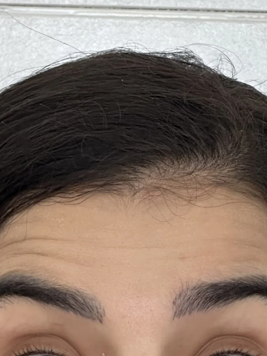 Antes da toxina botulínica em Natal/RN: linhas horizontais na testa