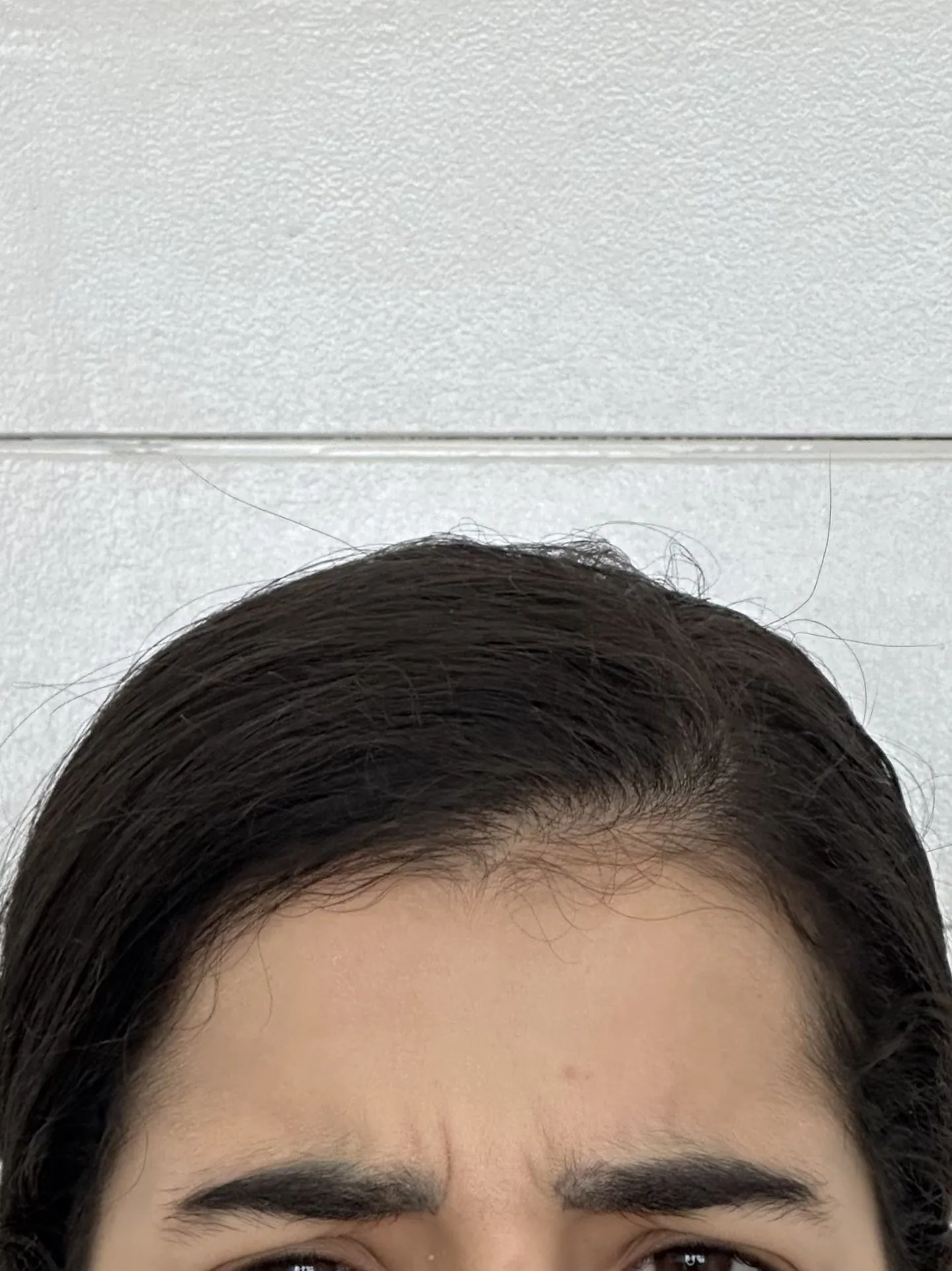 Antes da toxina botulínica