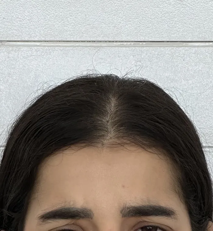 Depois da toxina botulínica