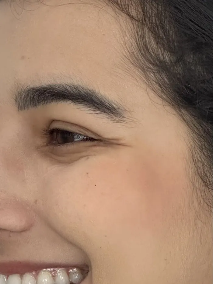 Antes da toxina botulínica: pés de galinha no canto externo dos olhos