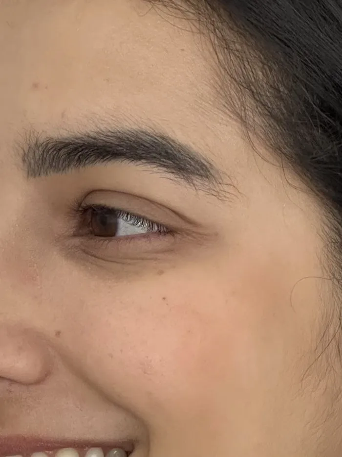 Depois da toxina botulínica em Natal/RN: pés de galinha suavizados