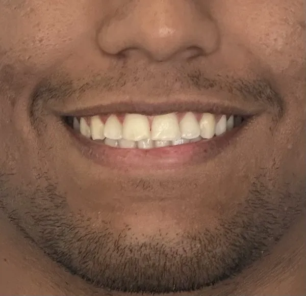 Antes do clareamento dental