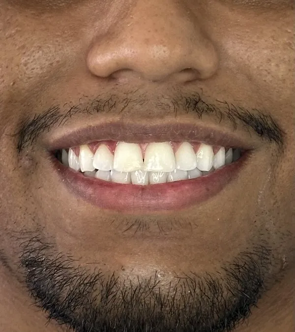 Depois do clareamento dental