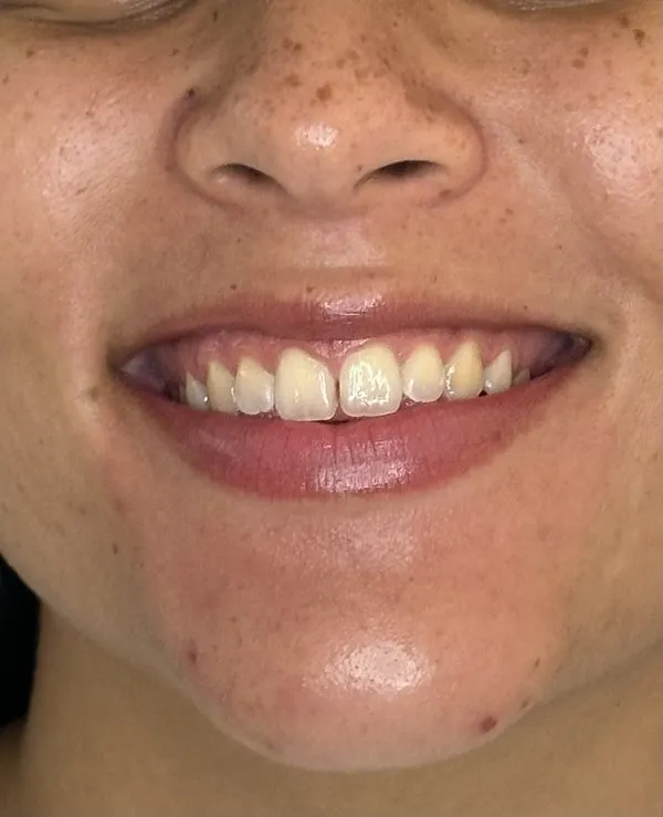 Antes do clareamento dental: esmalte manchado por pigmentação em Natal/RN