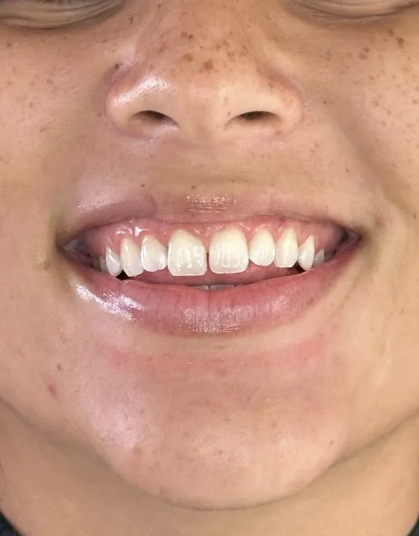 Depois do clareamento dental: tonalidade uniforme e luminosa