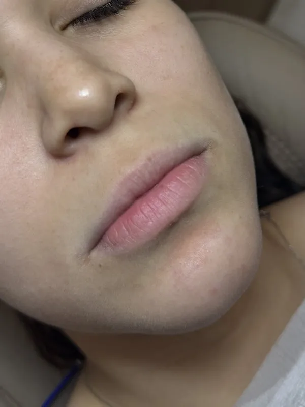 Antes do preenchimento facial