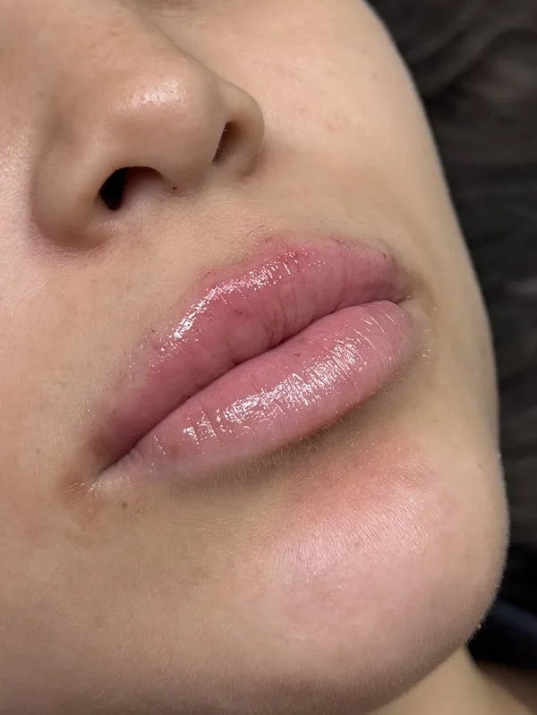 Depois do preenchimento facial