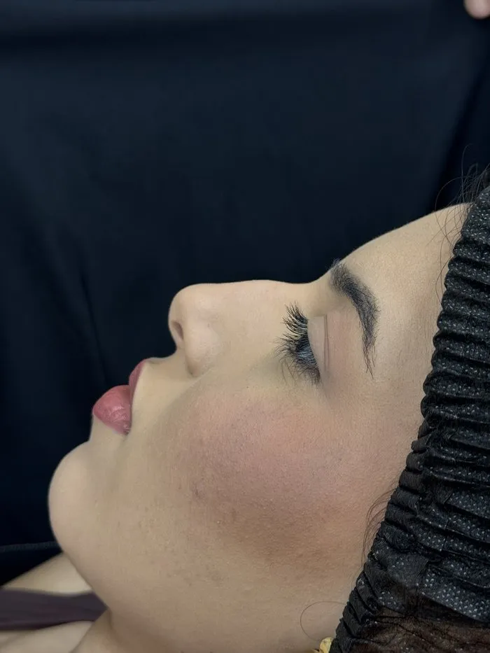 Depois da rinomodelação e preenchimento de mento: perfil harmonizado